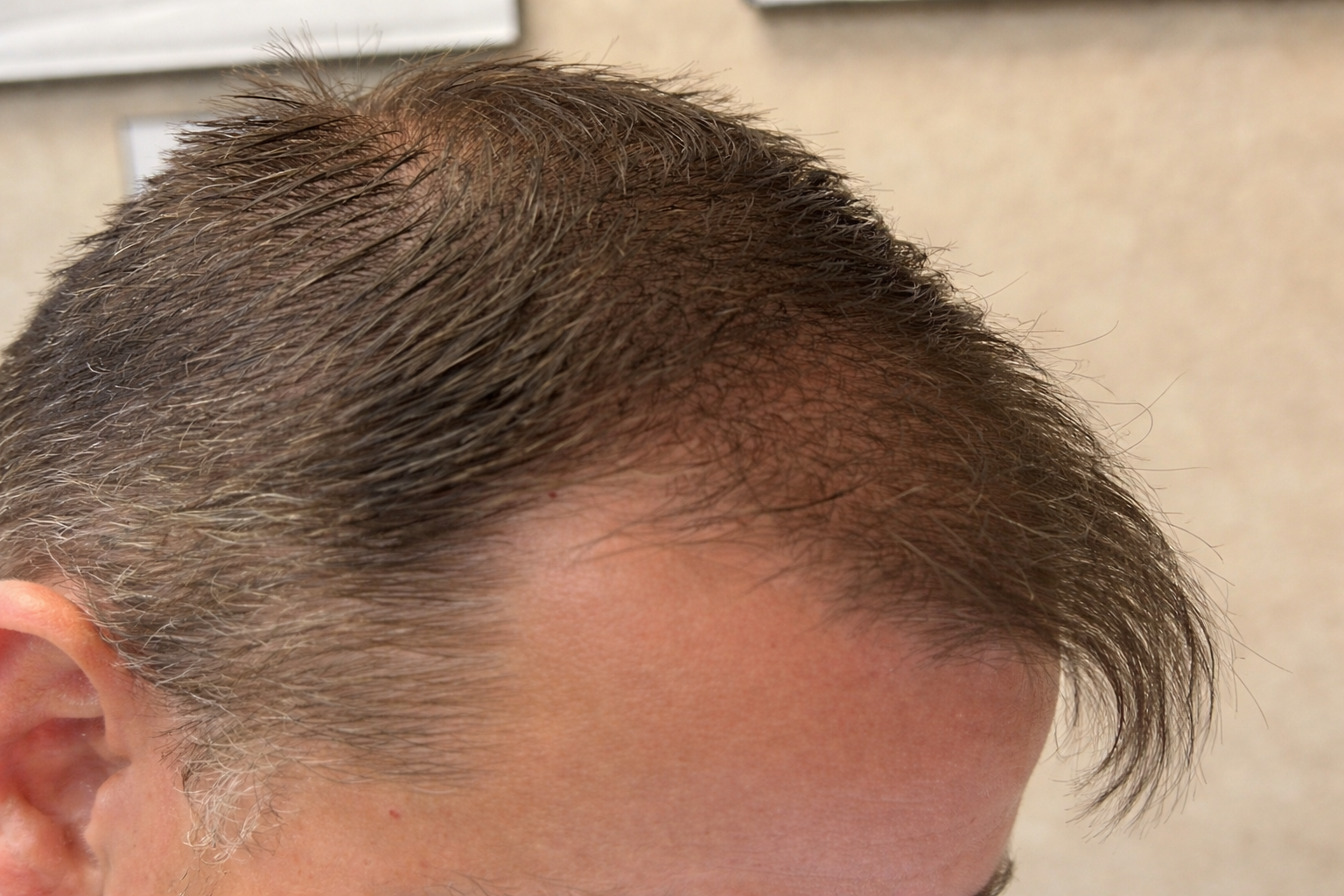 Hair Restoration, Knoxville Med Spa After Photo