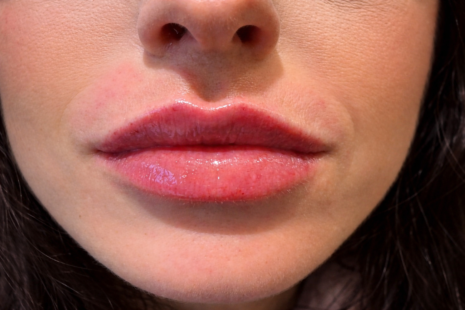 HR Lip Fillers After Photo