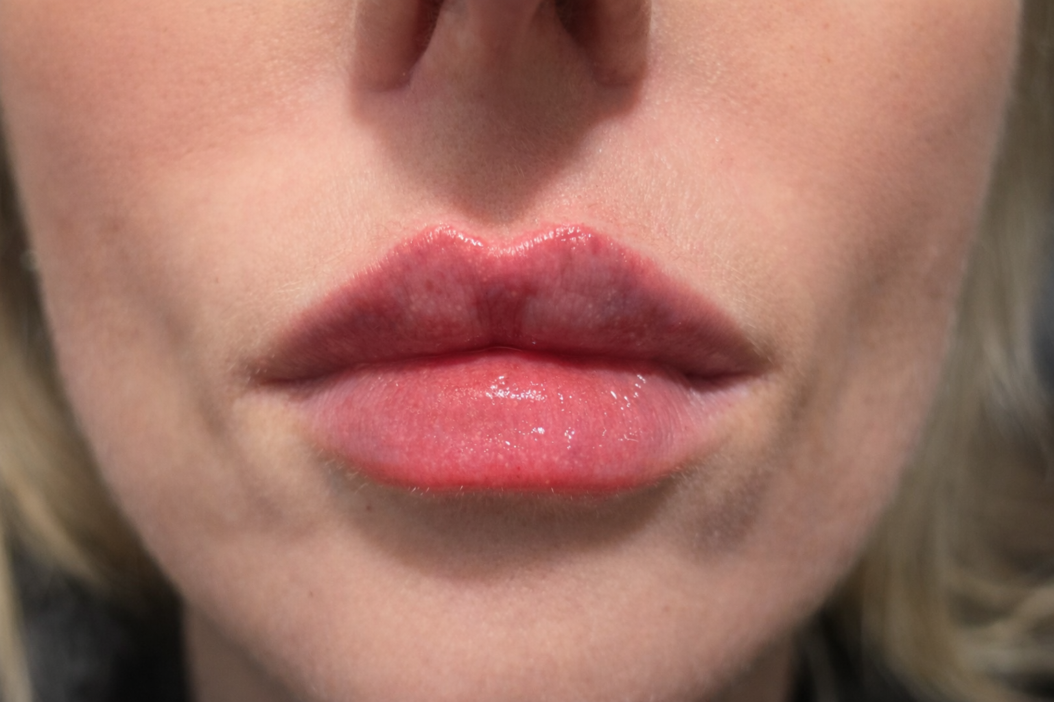 After RHA-2 Lip Fillers